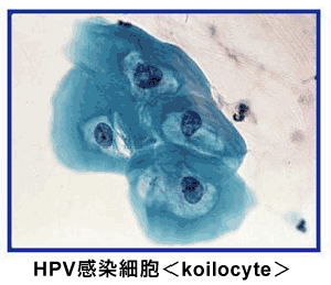 ウイルス ヒトパピローマ ヒトパピローマウイルス（HPV）検査とHPV感染予防ワクチン －婦人科－｜KOMPAS