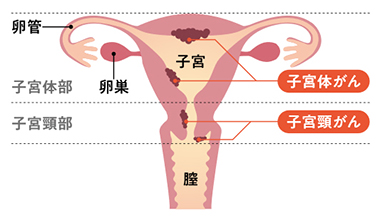 子宮 頚 が ん